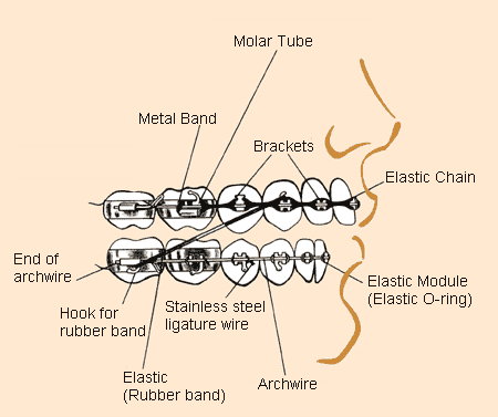 braces_diagram