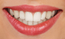 Ceramic or clear braces