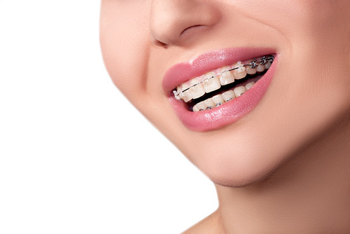 What are Lingual Braces?