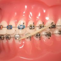 How Long Does Orthodontic Treatment Take? ortho-treatment-braces