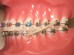 ortho-treatment-braces