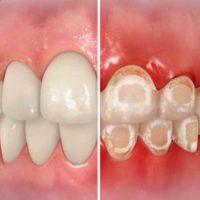 What Causes White Marks to Form Around Braces in Some Patients? teeth-decalcify