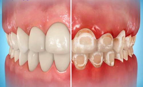 causes for white spots on teeth