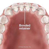 Why Retainers bonded