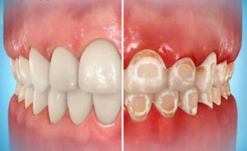 Teeth decalcify from orthodontics