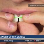 Dangers of DIY braces in Boise